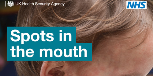 Measles spots in the mouth